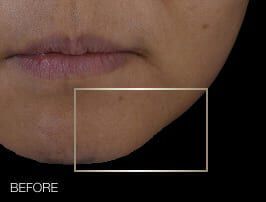 Helena Rubinstein: reduccion del -14% de la ptosis en la parte inferior del rostro tras 28 dias, revelando una mandibula mas definida.