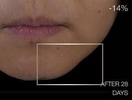 Primer plano de la parte inferior del rostro antes del tratamiento, con signos de laxitud cutanea y falta de definicion en la linea de la mandibula.